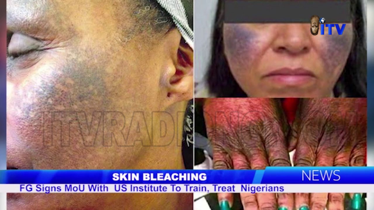 Skin Bleaching: FG Signs MoU With US Institute To Train, Treat Nigerians